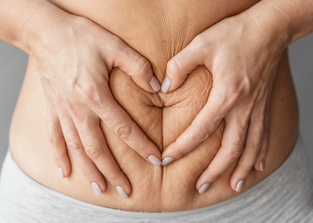 image 3 Cara Menghilangkan Stretch Mark Paling Ampuh
