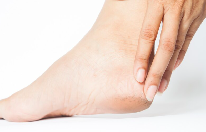 image Cara Menghilangkan Kaki Pecah-Pecah Dengan Bahan Alami